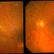 Acute retinal necrosis